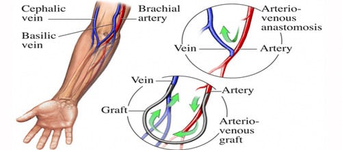 AV graft creation