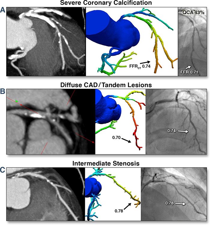 severe coronary calcification