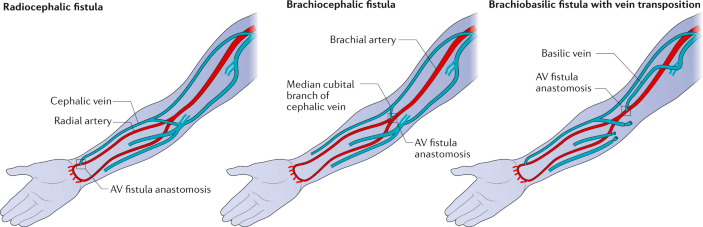 AV fistula creation