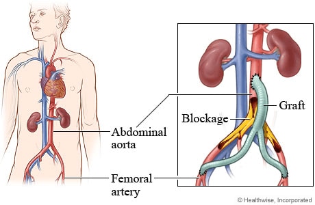 Arterial Bypasses