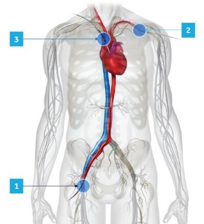 TAVR Diagram