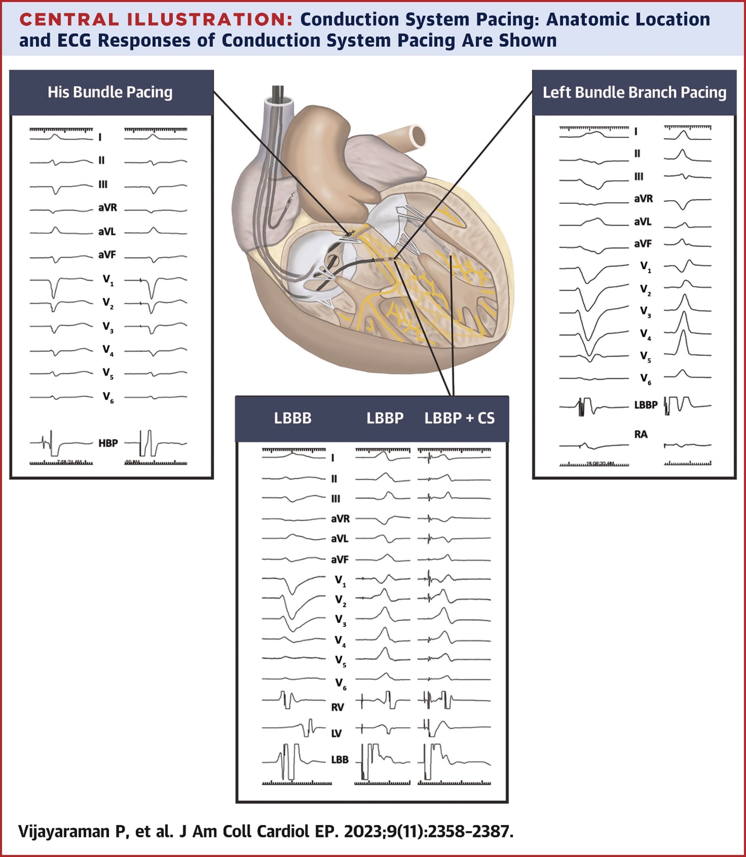 Conduction System Pacing