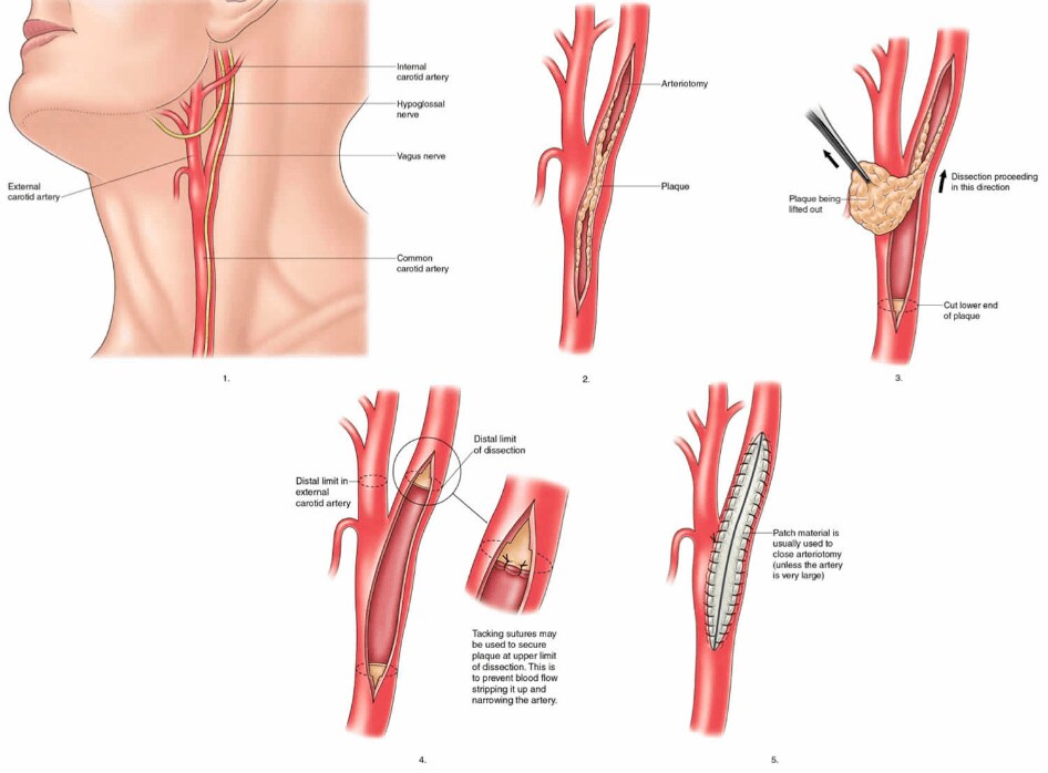 carotid endarterectomy (CEA)